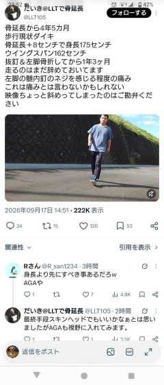 【画像】骨延長で175cmの身長を手に入れた人現る・・・