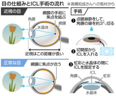 ICL手術怖すぎると話題に