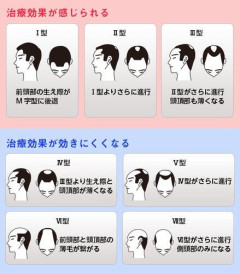【悲報】ハゲてるほうがガチで有利な仕事ってある?wwwwwwwwww