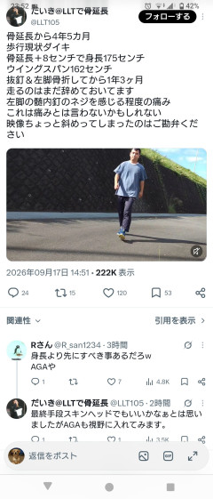 【画像】骨延長で175cmの身長を手に入れた人現る