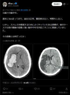【悲報】首をｺﾞｷｺﾞｷ鳴らしまくってた男性の末路…