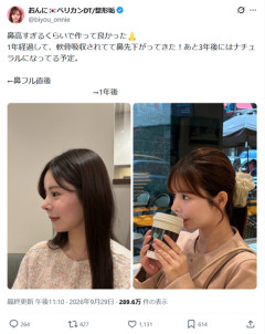 【朗報】鼻整形、「ゆっくりと元に戻る」ことを想定してかなり高めに仕上げていたｗｗｗｗ