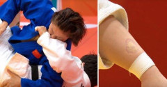 【悲報】アジア大会の柔道で中国選手が「かみつき」失格、被害受けた前田さんの腕にはくっきり歯形wwwwwwwwww