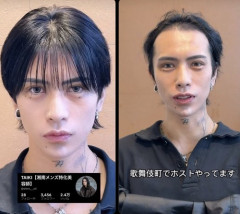 【悲報】歌舞伎町のホスト、整形の副作用でとんでもないことになるｗｗｗｗｗ