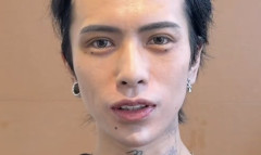 イケメンホストさん、おでこが広すぎるため整形で縮小→術後まさかの事態に・・・