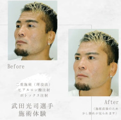 【悲報】人気格闘家が二重整形した結果ｗｗｗｗｗｗｗｗｗｗｗｗ