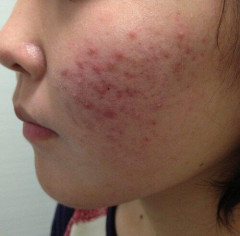【悲報】ワイ、ニキビ直したいけど何すればいいか分からないｗｗｗｗｗｗｗｗｗｗ