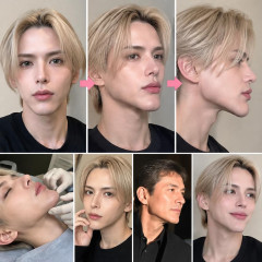 Matt、「顎が3cm伸びた」ヒアルロン酸で顔面が変化した写真公開「溶かしてもらった」父の顎に憧れも…「もう入れるのやめる」   |  今こんなんだぞ