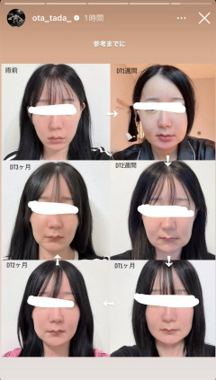 【謎】女さん、何故か顎の骨を削って自分からブルドッグになりに行くｗｗｗ