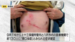 【画像】雷魚を生で食べた男の子さん、一生消えないアザができて終わるｗｗｗｗｗｗｗｗｗｗ