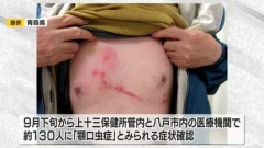 【画像】雷魚を生で食べた男の子、一生消えないアザができて終わる・・・