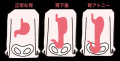 【画像】『胃下垂』を放置し続けた人、”こう”なる…