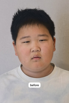 【悲報】クラスに1人はいる系の小学生、美容整形でとんでもない事になってしまうｗｗｗｗ