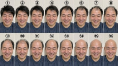 【画像】薄毛は「何番」からなのか、議論が分かれてしまうｗｗｗｗｗ
