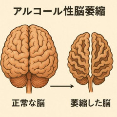 【困惑】酒って脳の老化早める?wwwwwwwwww
